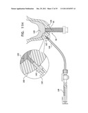 DENTAL IMPLANT HAVING A RECESSED SURFACE FOR SEALING diagram and image