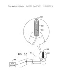 DENTAL IMPLANT HAVING A RECESSED SURFACE FOR SEALING diagram and image