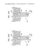 DENTAL IMPLANT HAVING A RECESSED SURFACE FOR SEALING diagram and image