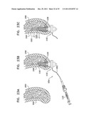 DENTAL IMPLANT HAVING A RECESSED SURFACE FOR SEALING diagram and image