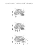 DENTAL IMPLANT HAVING A RECESSED SURFACE FOR SEALING diagram and image