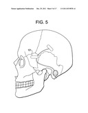 Red Light Implants for Treating Postpartum Depression diagram and image