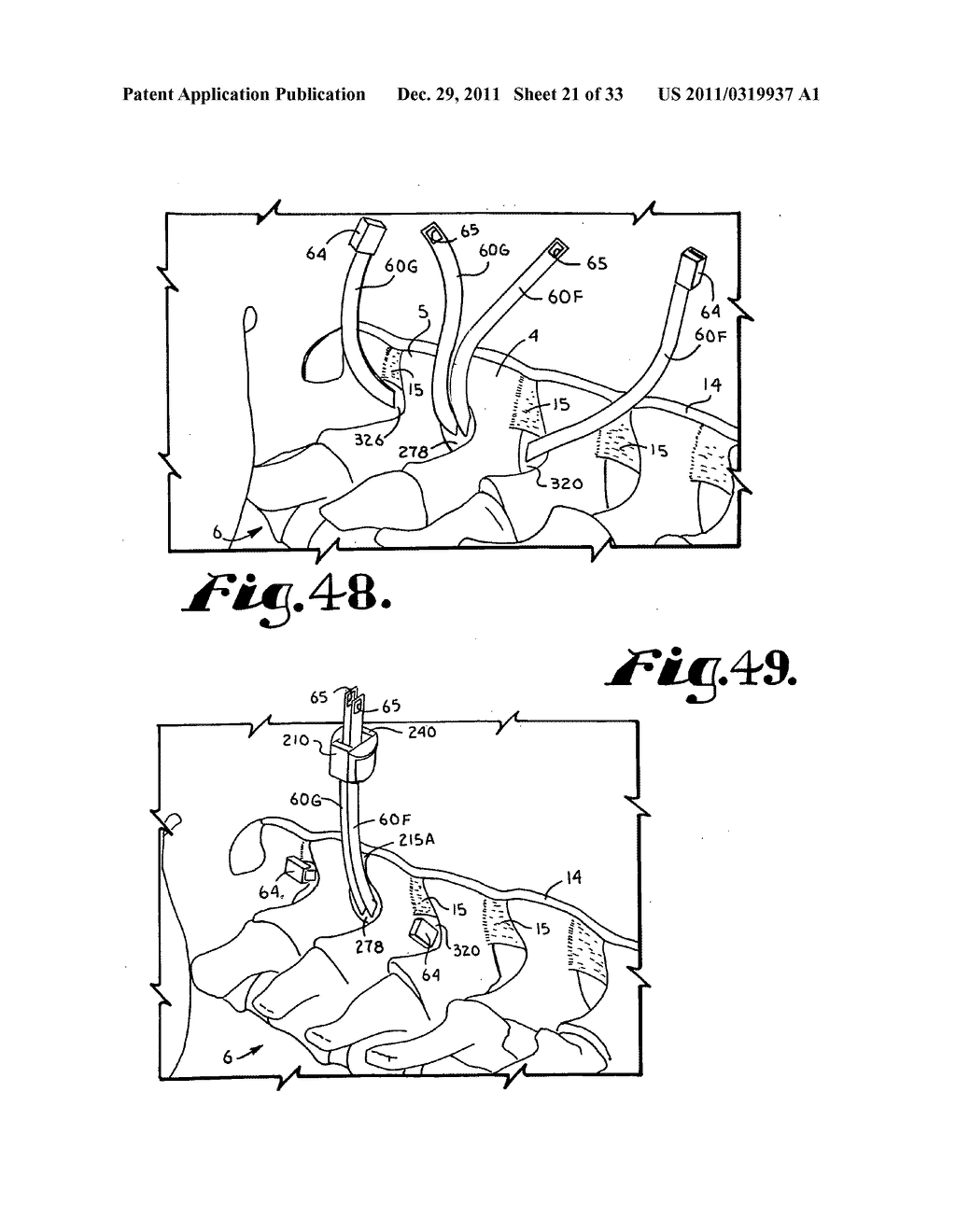 Side-loading interspinous process spacer an installation tool - diagram, schematic, and image 22