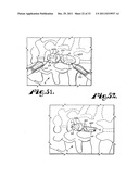 Side-loading interspinous process spacer an installation tool diagram and image