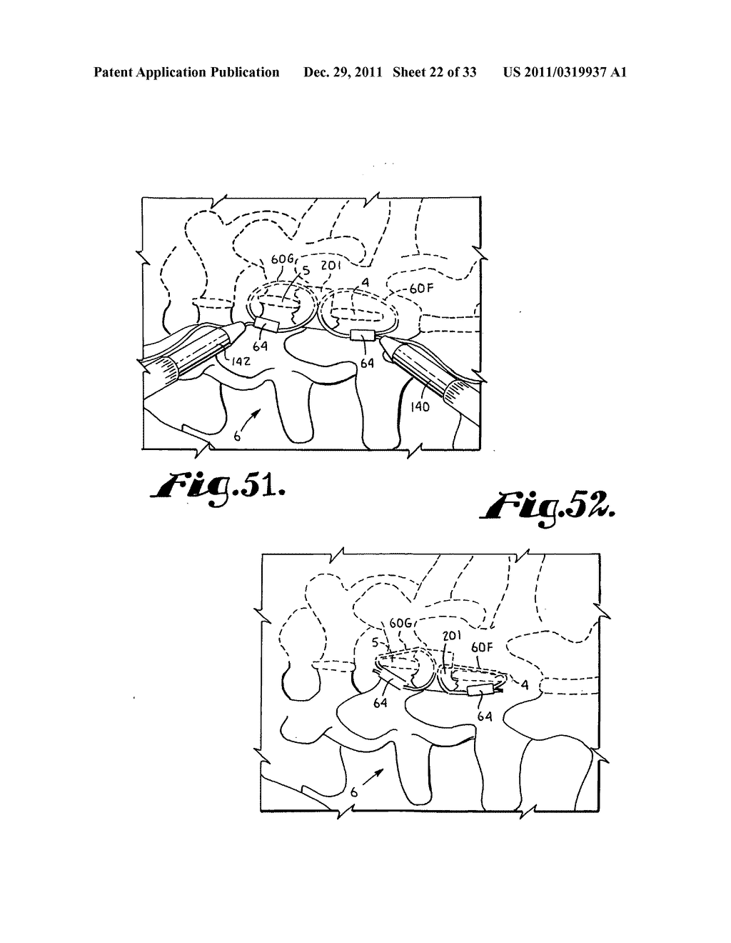 Side-loading interspinous process spacer an installation tool - diagram, schematic, and image 23