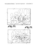 Side-loading interspinous process spacer an installation tool diagram and image