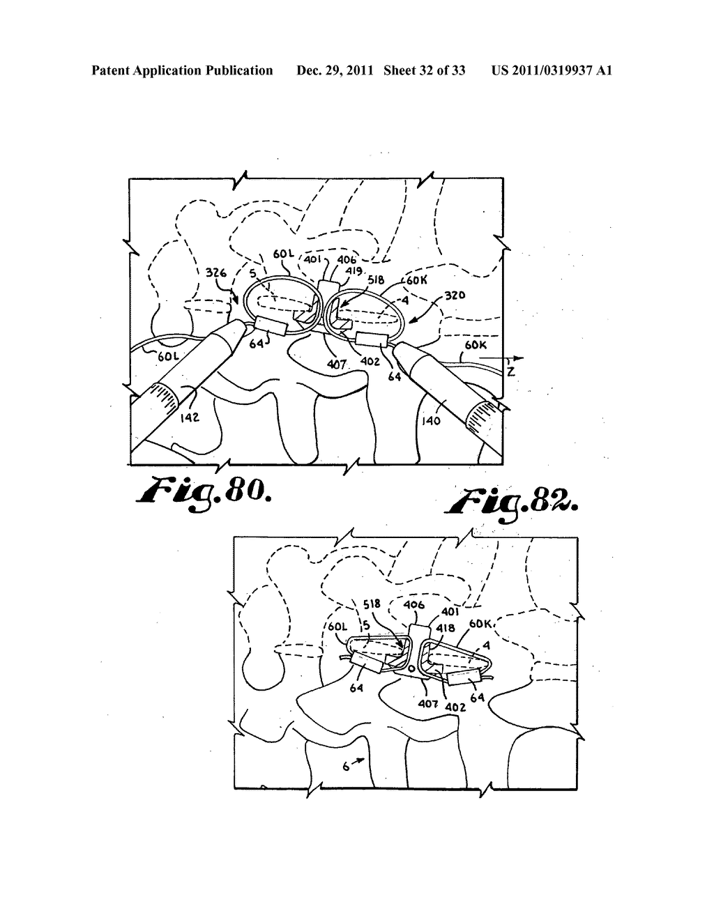 Side-loading interspinous process spacer an installation tool - diagram, schematic, and image 33