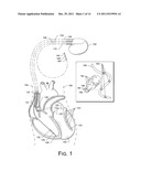 METRICS AND TECHNIQUES FOR OPTIMIZATION OF CARDIAC THERAPIES diagram and image