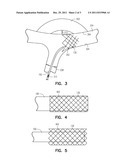 LEAD FOR STIMULATING THE BARORECEPTORS IN THE PULMONARY ARTERY diagram and image