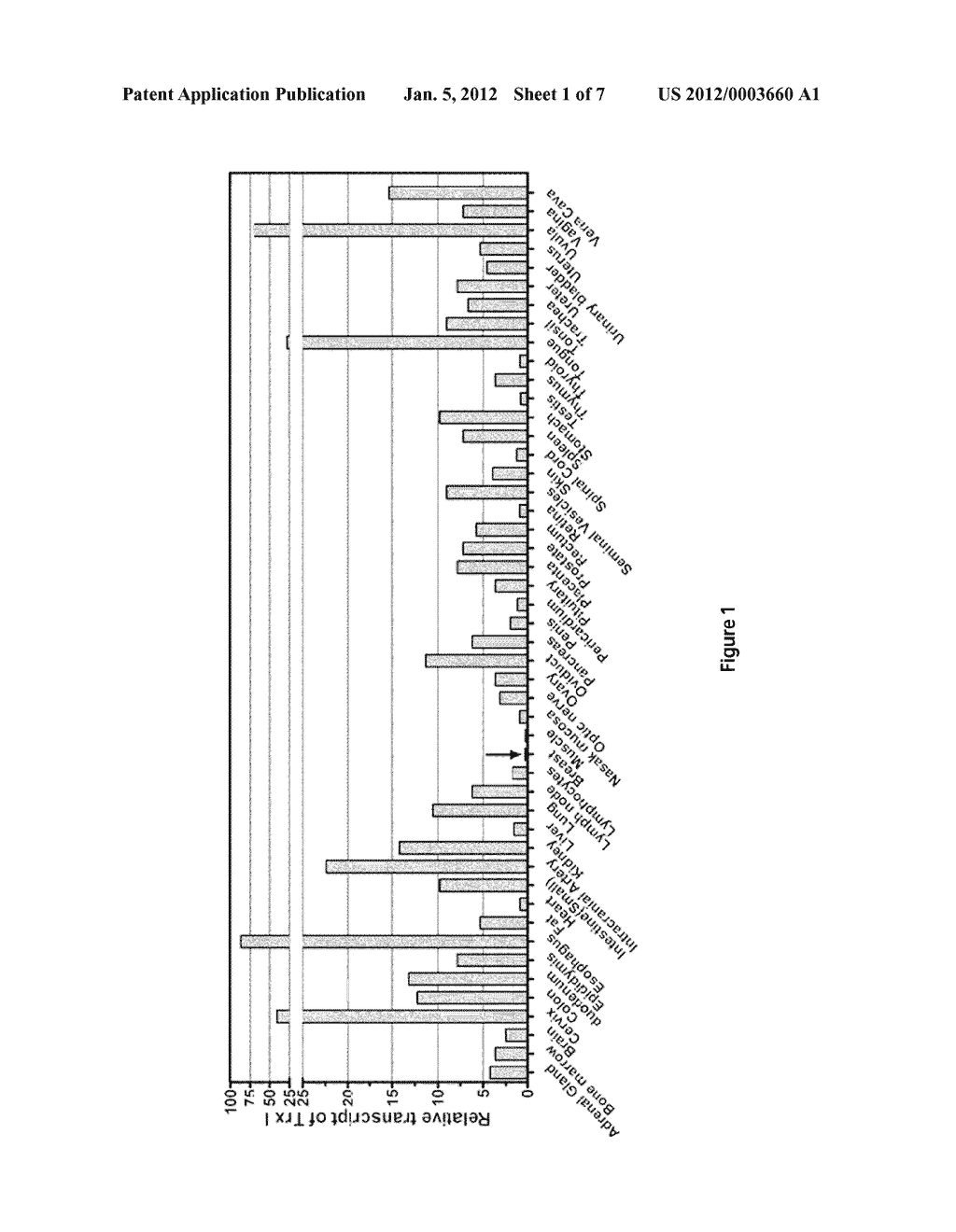 DIAGNOSIS OR PROGNOSIS OF BREAST CANCER BASED ON EXPRESSION LEVEL OF     THIOREDOXIN-1 - diagram, schematic, and image 02