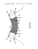 SYSTEMS, DEVICES, AND METHODS FOR SUB-URETHRAL SUPPORT diagram and image