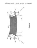 SYSTEMS, DEVICES, AND METHODS FOR SUB-URETHRAL SUPPORT diagram and image