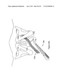 SYSTEMS, DEVICES, AND METHODS FOR SUB-URETHRAL SUPPORT diagram and image