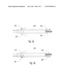 System and Method for Treating Hemorrhoids diagram and image