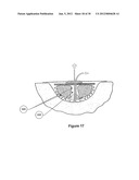 WOUND DRESSING APPARATUS AND METHOD OF USE diagram and image