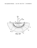 WOUND DRESSING APPARATUS AND METHOD OF USE diagram and image