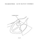 ROBOTIC CATHETER SYSTEM diagram and image