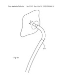 ROBOTIC CATHETER SYSTEM diagram and image