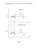 ROBOTIC CATHETER SYSTEM diagram and image