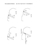 ROBOTIC CATHETER SYSTEM diagram and image