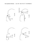 ROBOTIC CATHETER SYSTEM diagram and image