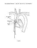 ROBOTIC CATHETER SYSTEM diagram and image