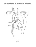 ROBOTIC CATHETER SYSTEM diagram and image