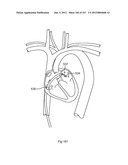 ROBOTIC CATHETER SYSTEM diagram and image