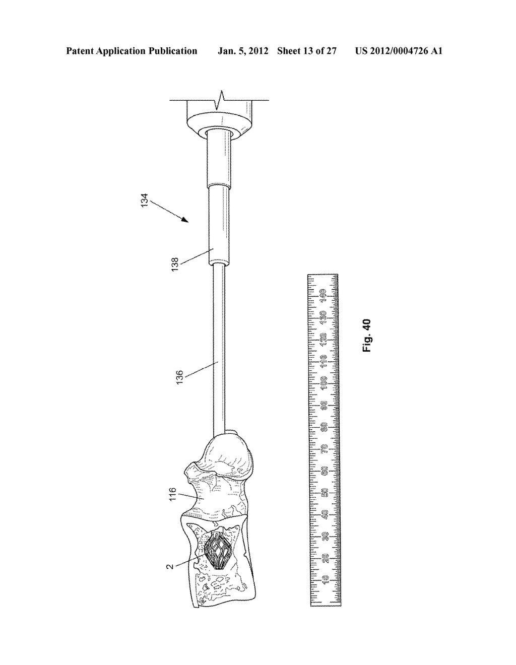 EXPANDABLE SUPPORT DEVICE AND METHOD OF USE - diagram, schematic, and image 14