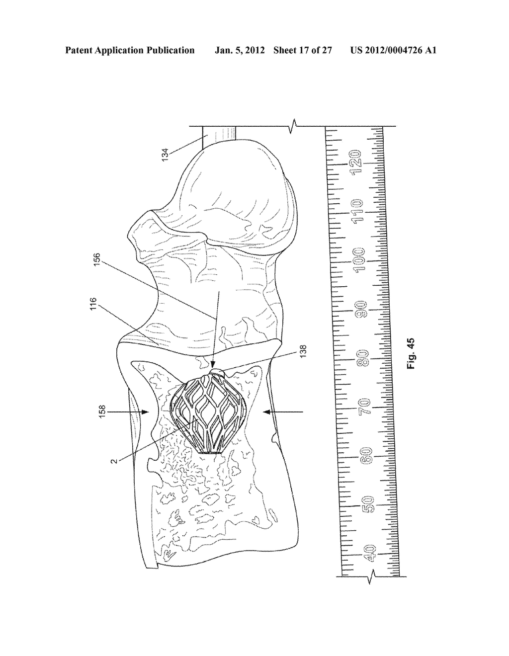 EXPANDABLE SUPPORT DEVICE AND METHOD OF USE - diagram, schematic, and image 18