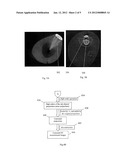 Method and apparatus for 3d metal and high-density artifact correction for     cone-beam and fan-beam ct imaging diagram and image