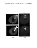 Method and apparatus for 3d metal and high-density artifact correction for     cone-beam and fan-beam ct imaging diagram and image