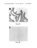 Reagents and Methods for Assessment of Human Tumor Malignancy and for     Targeting Malignant Tumor Cells diagram and image