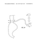 ASSEMBLY AND METHOD FOR AUTOMATICALLY CONTROLLING PRESSURE FOR A GASTRIC     BAND diagram and image