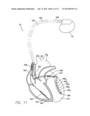 SYSTEM AND METHOD FOR EVALUATING MECHANICAL CARDIAC DYSSYNCHRONY BASED ON     MULTIPLE IMPEDANCE VECTORS USING AN IMPLANTABLE MEDICAL DEVICE diagram and image