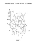 LOCAL DELIVERY OF THERAPEUTIC AGENT TO HEART VALVES diagram and image