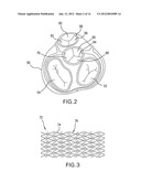 LOCAL DELIVERY OF THERAPEUTIC AGENT TO HEART VALVES diagram and image