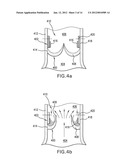 LOCAL DELIVERY OF THERAPEUTIC AGENT TO HEART VALVES diagram and image