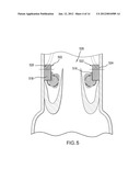 LOCAL DELIVERY OF THERAPEUTIC AGENT TO HEART VALVES diagram and image