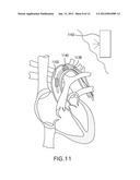 LOCAL DELIVERY OF THERAPEUTIC AGENT TO HEART VALVES diagram and image