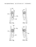 LOCAL DELIVERY OF THERAPEUTIC AGENT TO HEART VALVES diagram and image