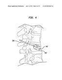 ORTHOPEDIC CEMENT AND USE OF SAME IN RADIATION THERAPY diagram and image