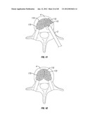 Methods and Apparatus For Treating Vertebral Fractures diagram and image