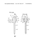 SPINAL STABILIZATION SYSTEM UTILIZING SCREW AND EXTERNAL FACET AND/OR     LAMINA FIXATION diagram and image