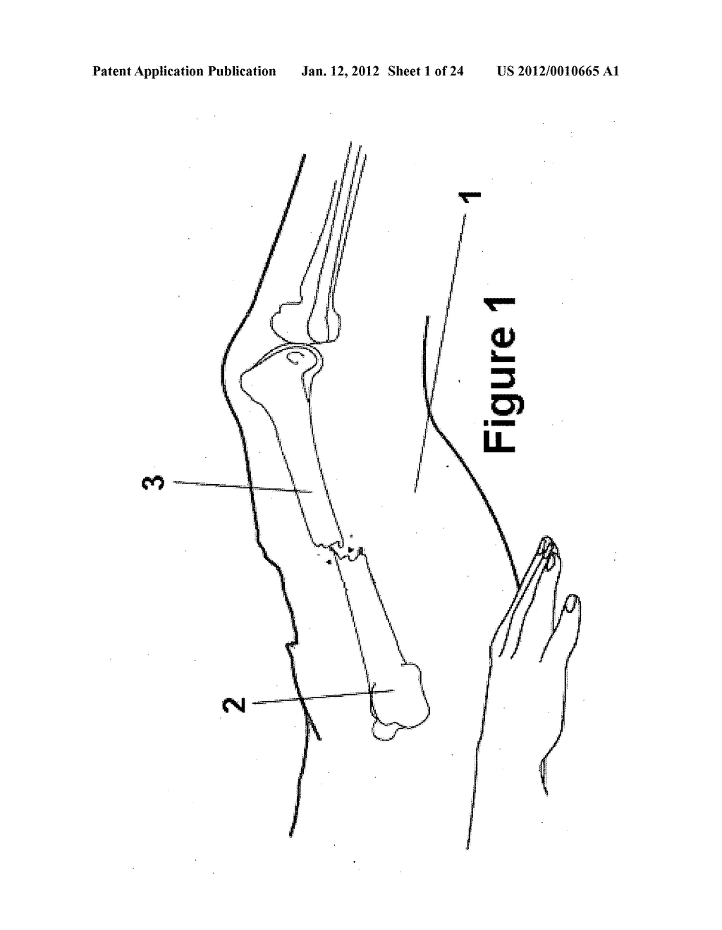 Method and apparatus for minimally invasive subcutaneous treatment of     humerus fractures - diagram, schematic, and image 02