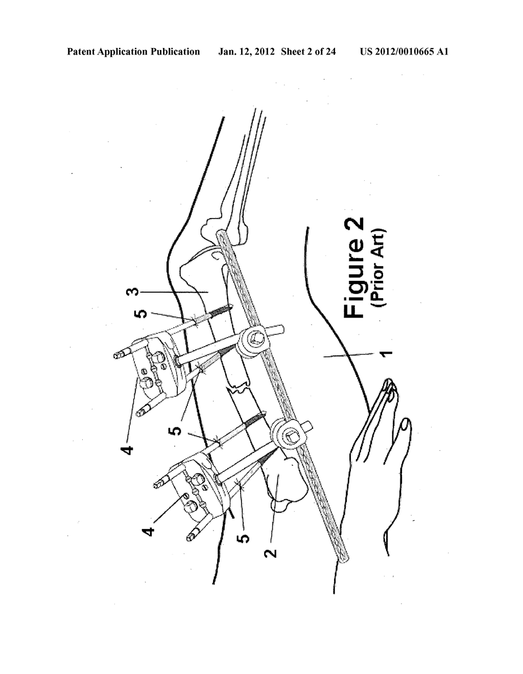 Method and apparatus for minimally invasive subcutaneous treatment of     humerus fractures - diagram, schematic, and image 03