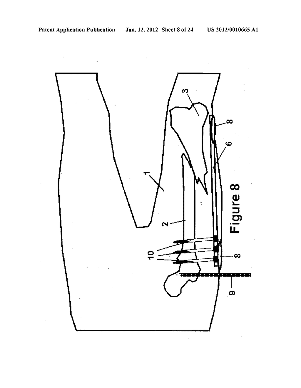 Method and apparatus for minimally invasive subcutaneous treatment of     humerus fractures - diagram, schematic, and image 09