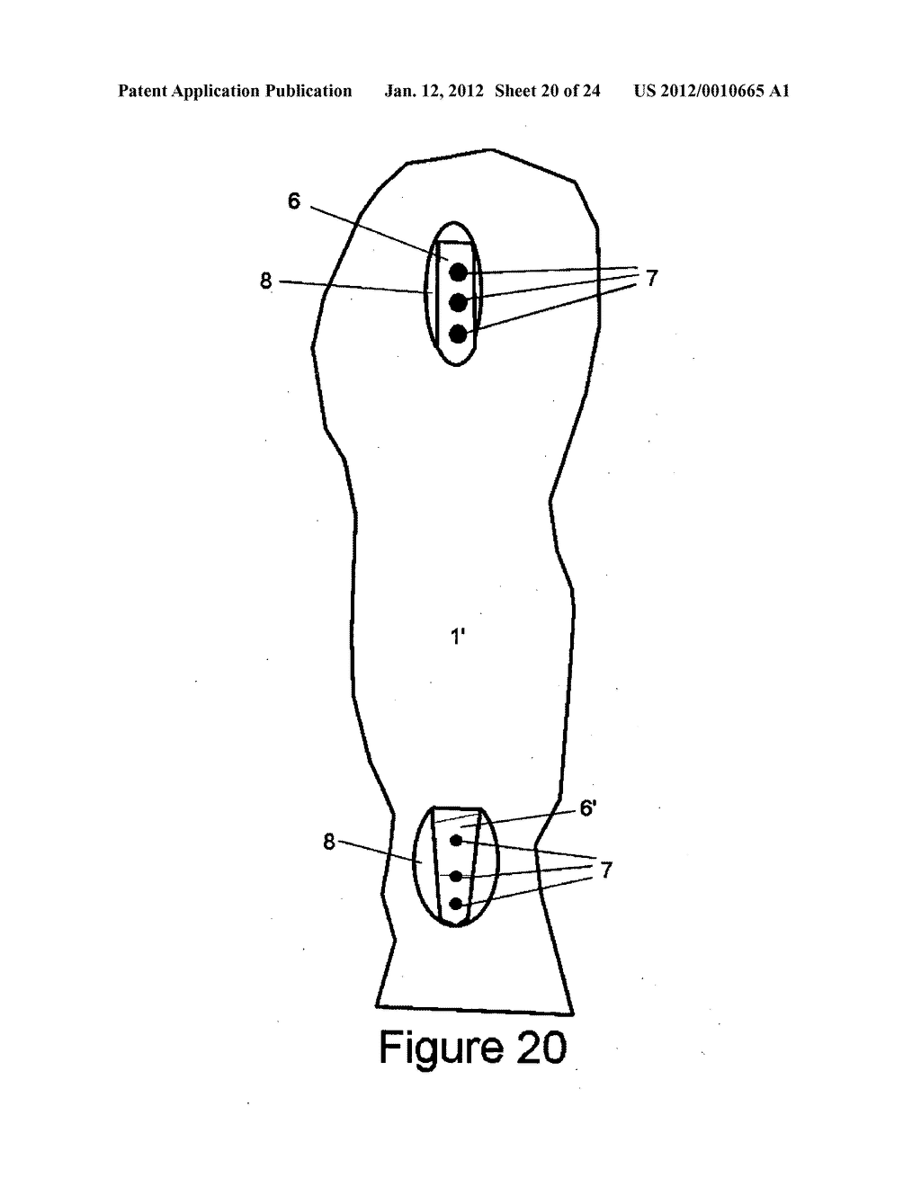 Method and apparatus for minimally invasive subcutaneous treatment of     humerus fractures - diagram, schematic, and image 21