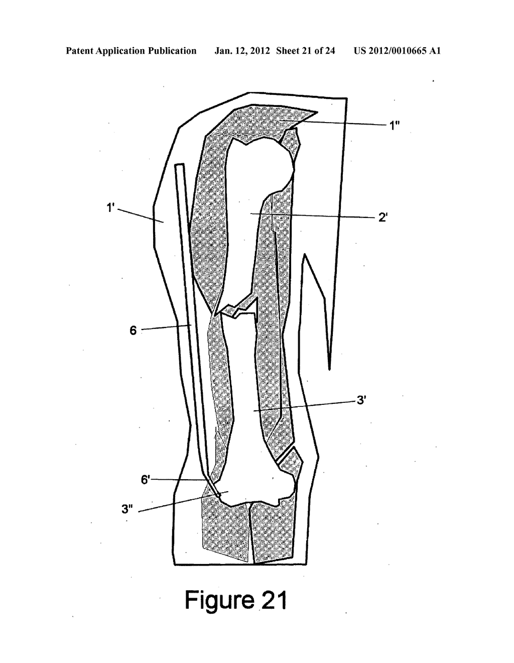 Method and apparatus for minimally invasive subcutaneous treatment of     humerus fractures - diagram, schematic, and image 22