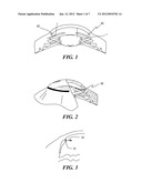 OPHTHALMIC IMPLANT FOR TREATMENT OF GLAUCOMA diagram and image